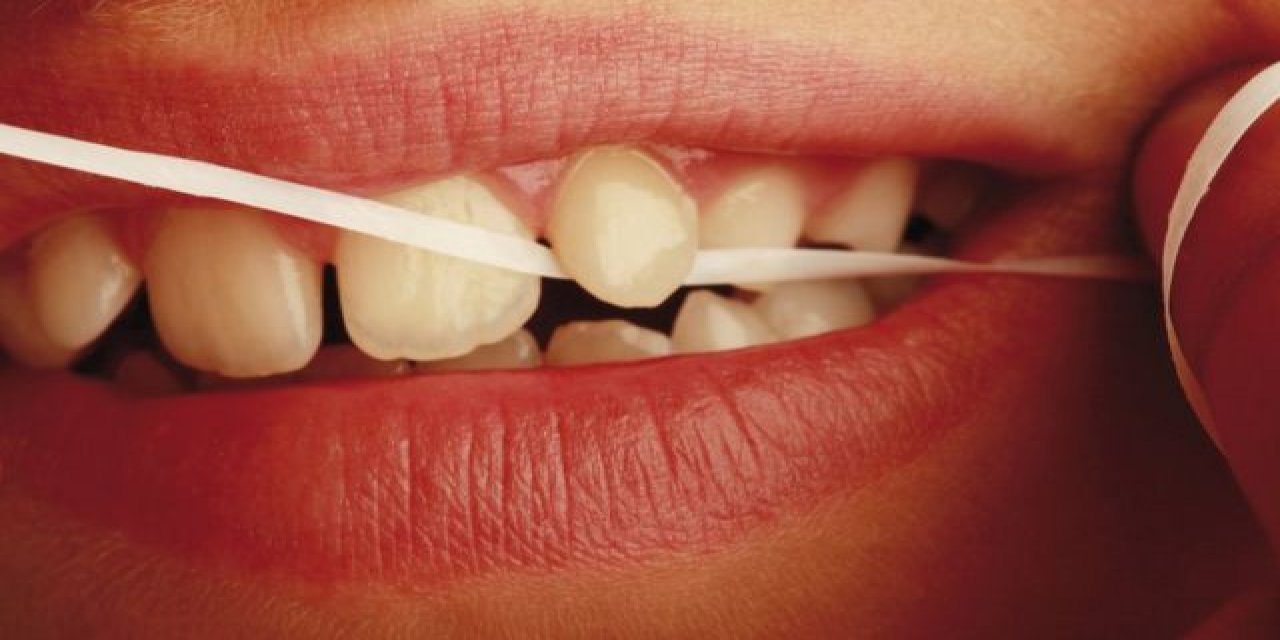 Diş çürüğü ve diş eti iltihabı diş ipi ile azaltılabilir