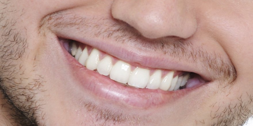 Uzmanlar uyarıyor: Diş beyazlatma sağlıklı değil